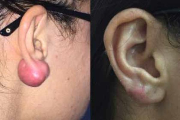 Fotos de paciente pre y post cirugía en el HOSPITAL UNIVERSITARIO AUSTRAL para tratamiento de reacción por colocación de piercing