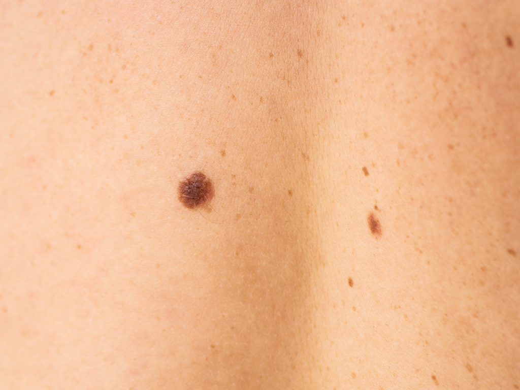 Y este lunar, ¿siempre fue así?