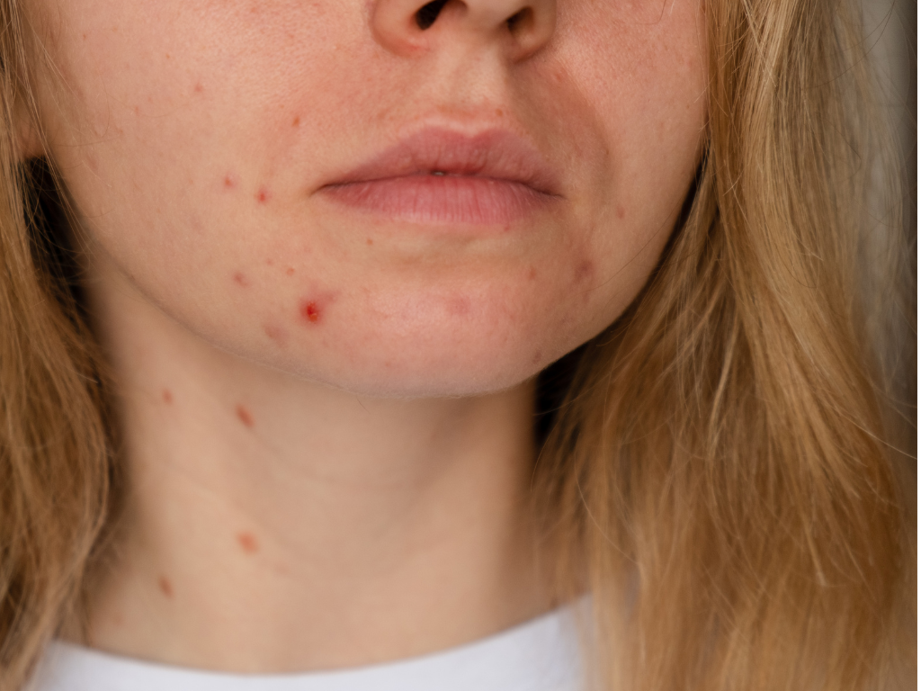 ¿Otra vez granos? El acné en la adultez