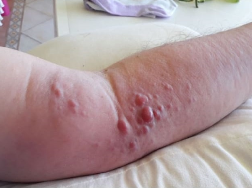 Carcinoma de Merkel: cuando el sol deja marcas y la medicina responde