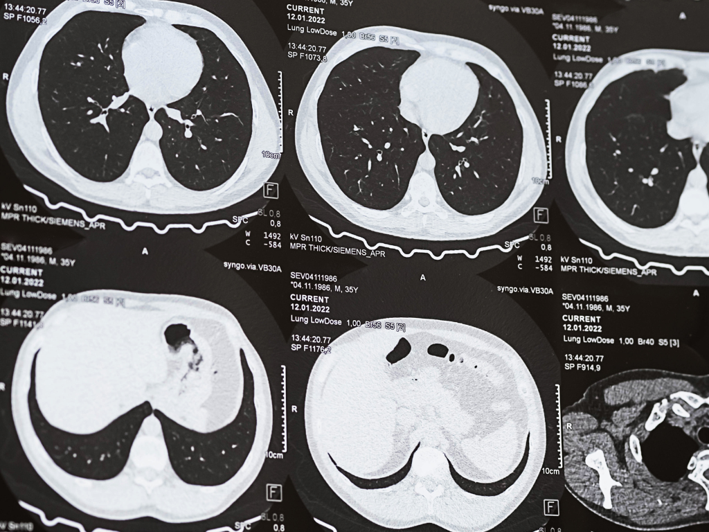 Cáncer de pulmón: llegar antes es posible Cáncer de pulmón: llegar antes es posible